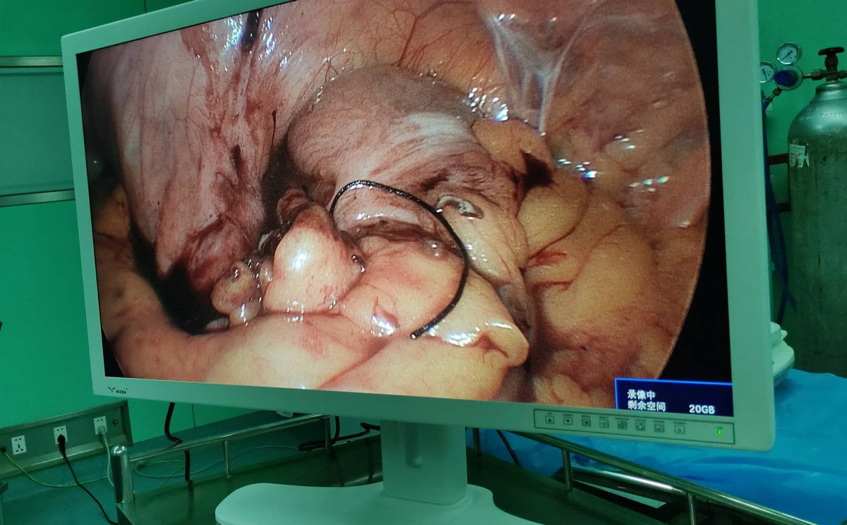 【益柯達】4K超高清內窺鏡攝像系統首次臨床 【益柯達】4K超高清內窺鏡攝像系統首次臨床