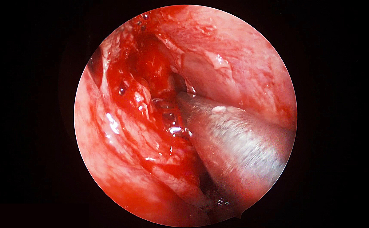 4K超高清內窺鏡攝像系統在腦垂體瘤切除術中的精彩表現 4K超高清內窺鏡攝像系統在腦垂體瘤切除術中的精彩表現