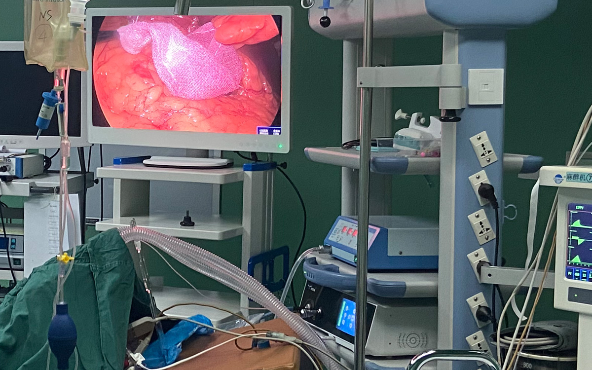 益柯達4K超高清內窺鏡攝像機臨床手術應用 益柯達4K超高清內窺鏡攝像機臨床手術應用