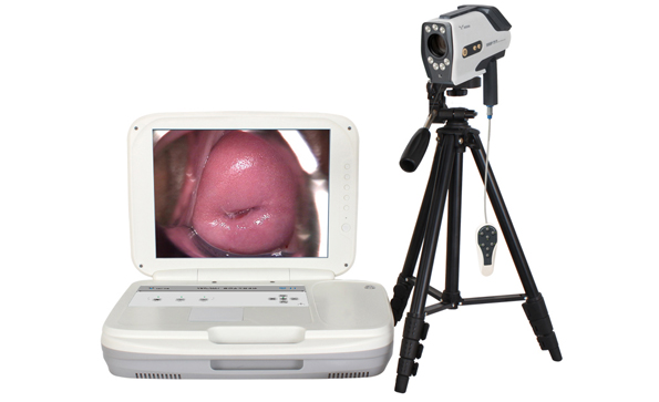 便攜式陰道鏡有哪些優勢？